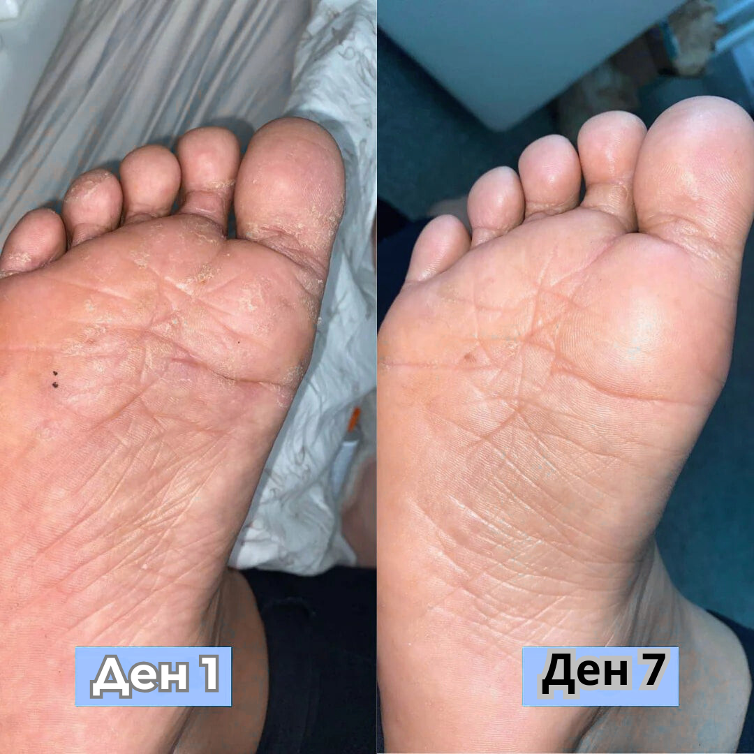 RootAura™ Крем за сухи и напукани пети